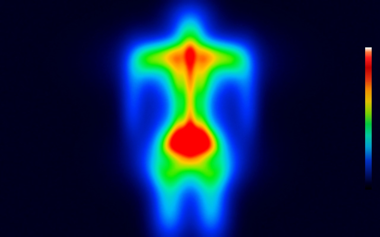 Infrared thermal imaging of the body — mapping areas of tension and inflammation